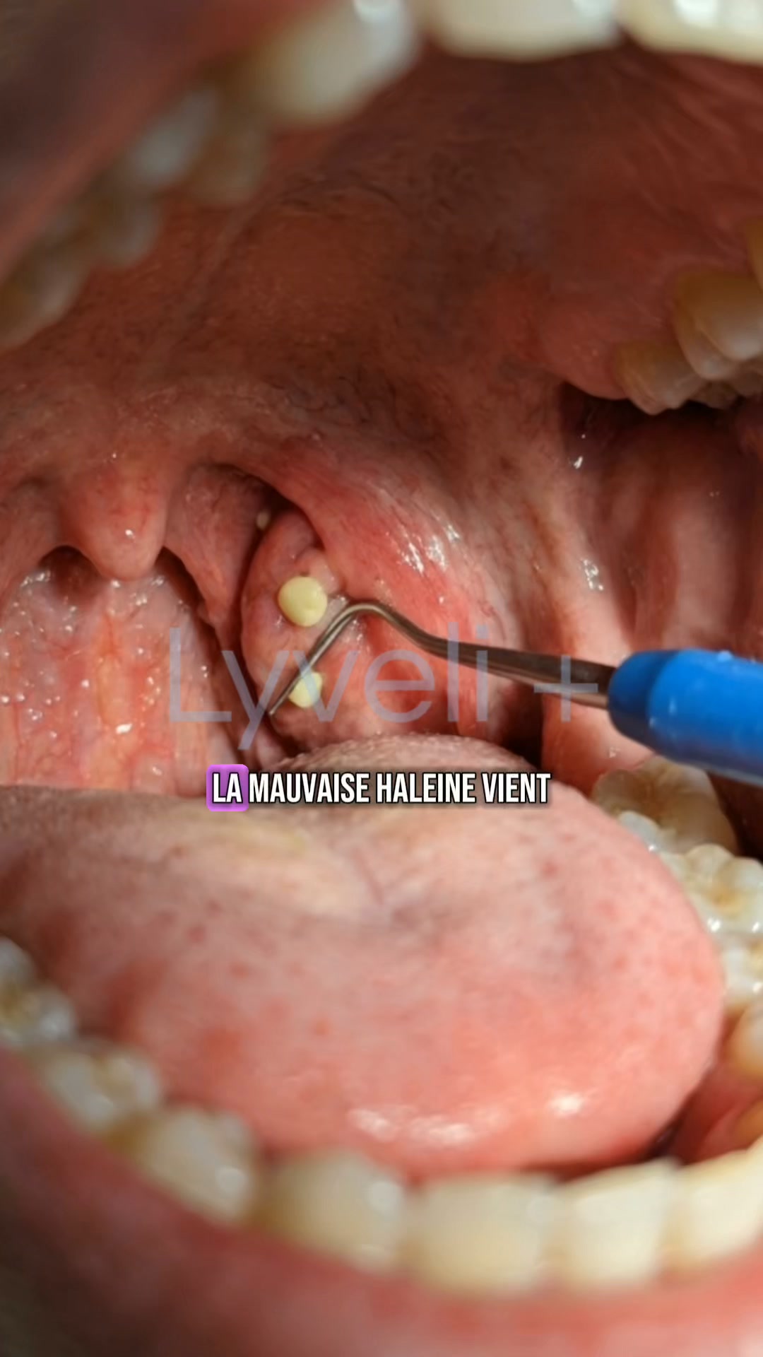 La solution contre la mauvaise haleine et la langue blanche