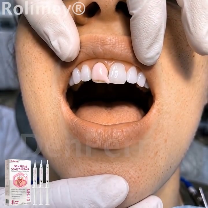 Cavity Repair FDA-Recognized 10% Nano-Hydroxyapatite (NH-10) | Delivery within 2-4 working days | Full refund guarantee