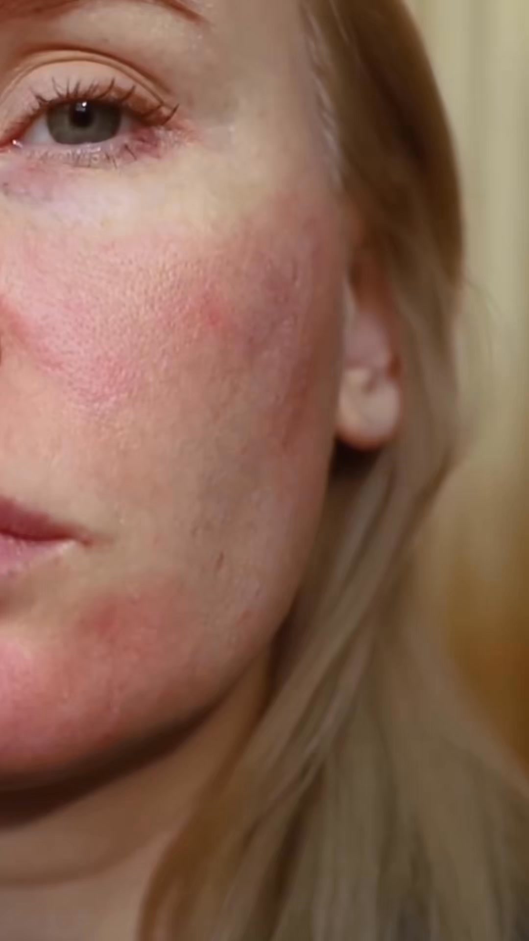 Rosacea & Targeted Skincare