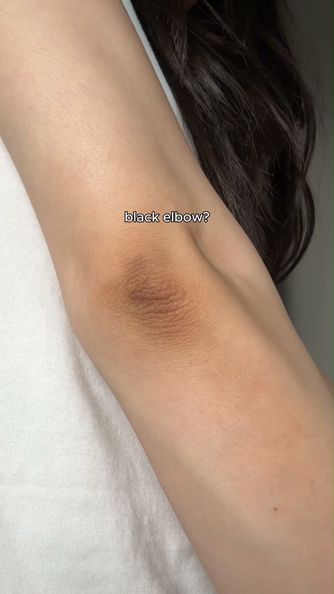 Dark Spots Gone In 2 Weeks