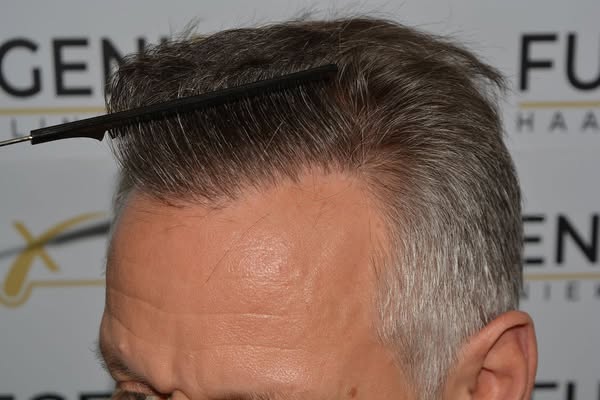 Art Gallery | FueGenix | Hair Restoration Artistry