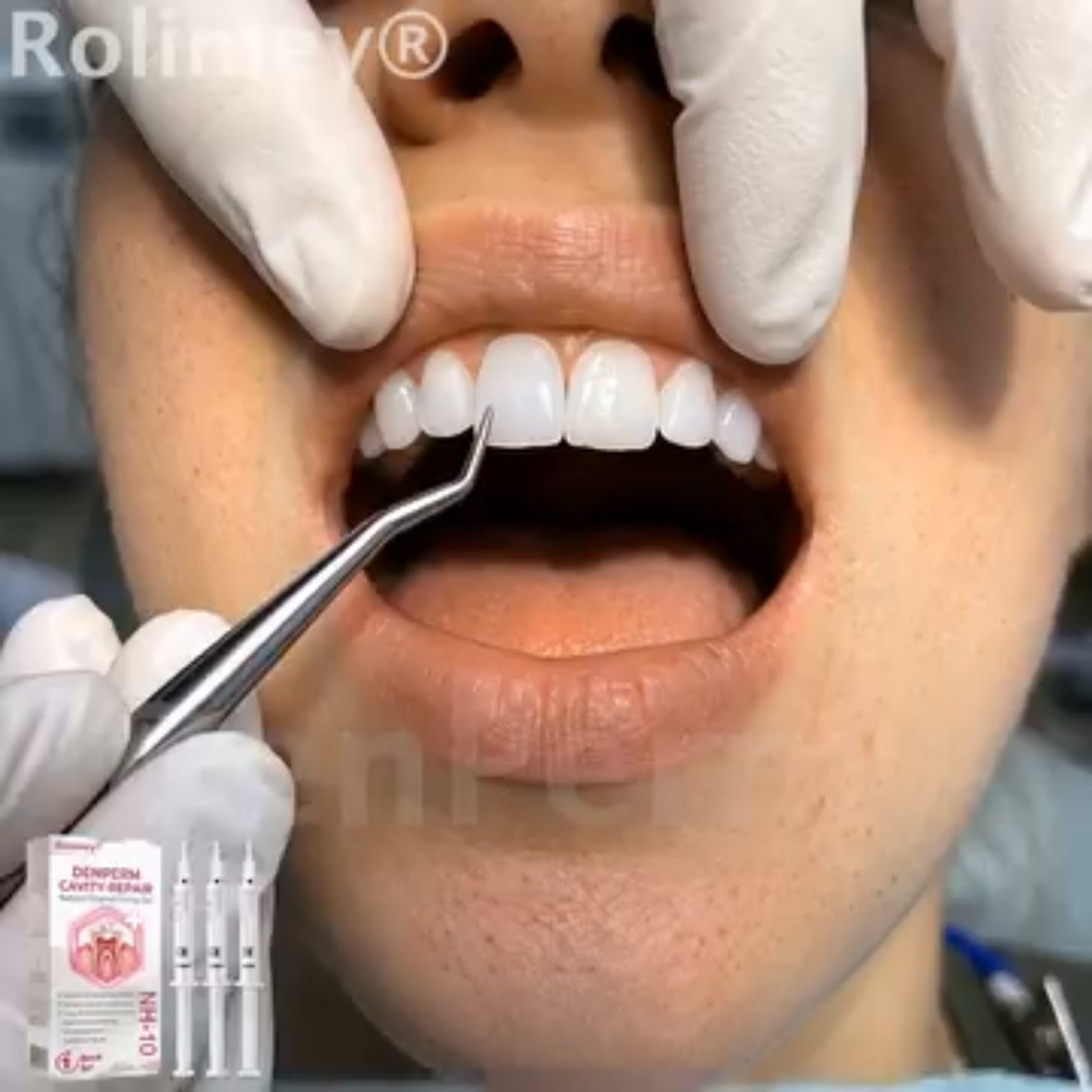 Bremvik® DenPerm Cavity-Repair Natural Enamel Filling Gel