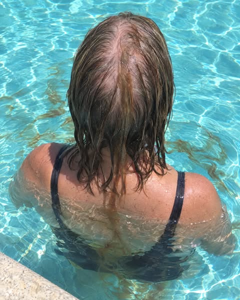 Offered minoxidil for life or a wig? Read this