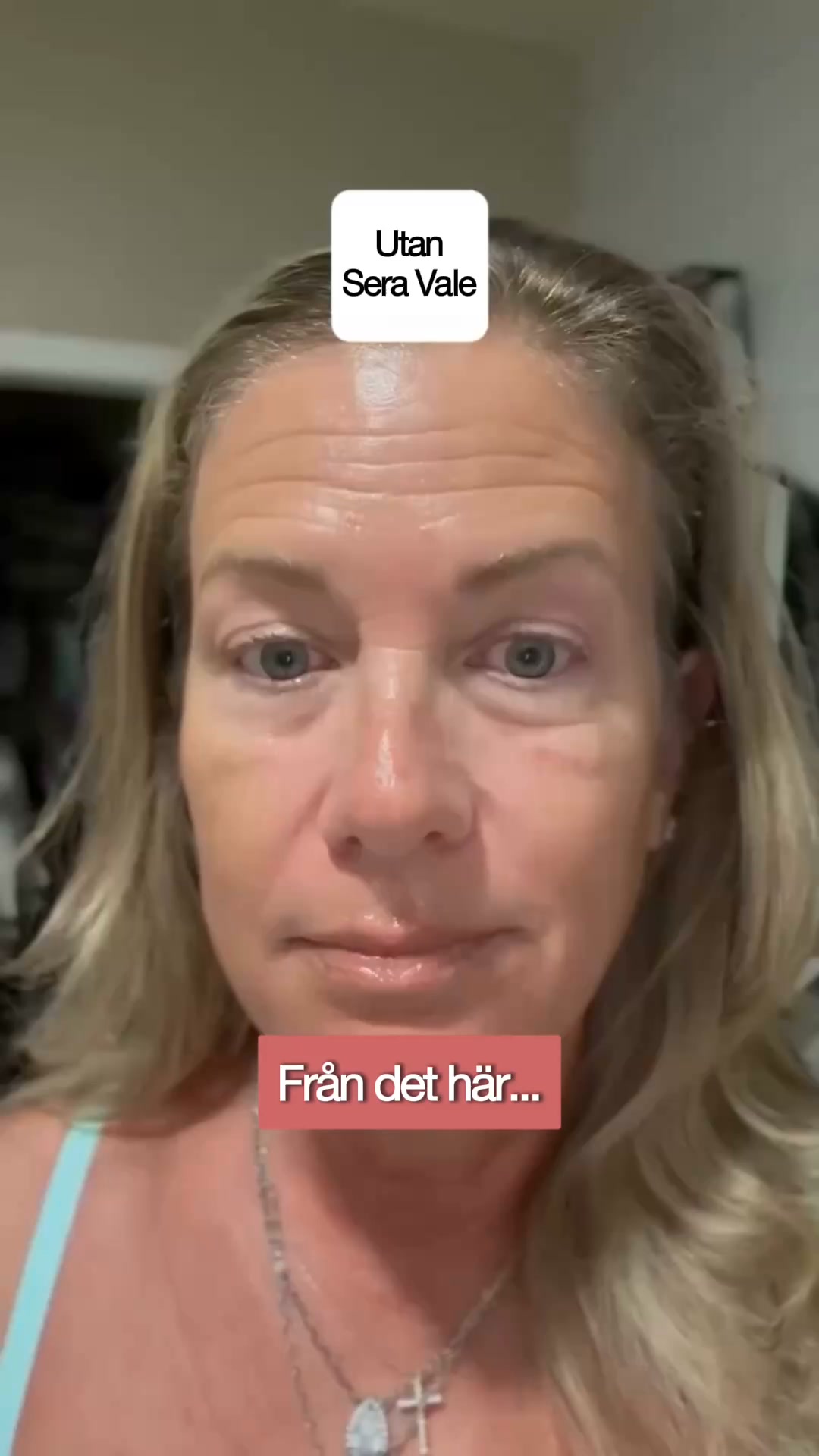 Slätare linjer utan botox