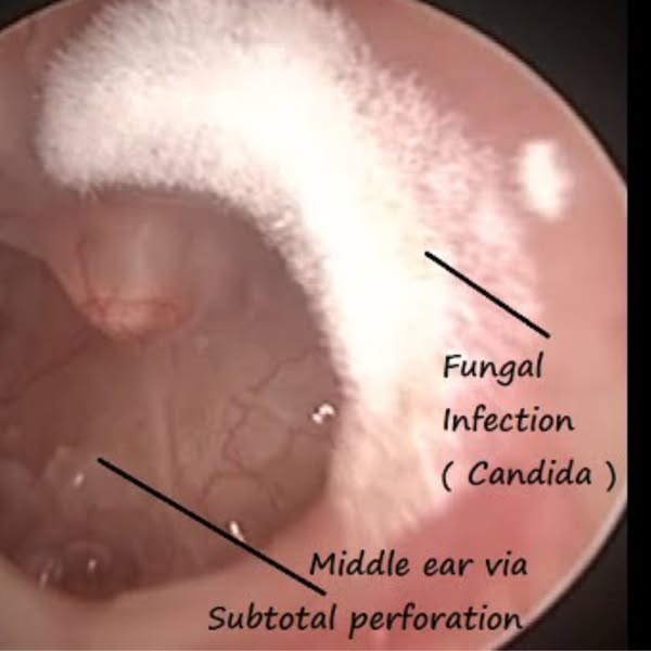 There is something growing in your ear...