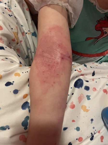 läs detta om ditt barn har eksem.