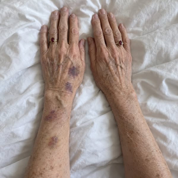 Read this if you wake up to bruises you cannot explain