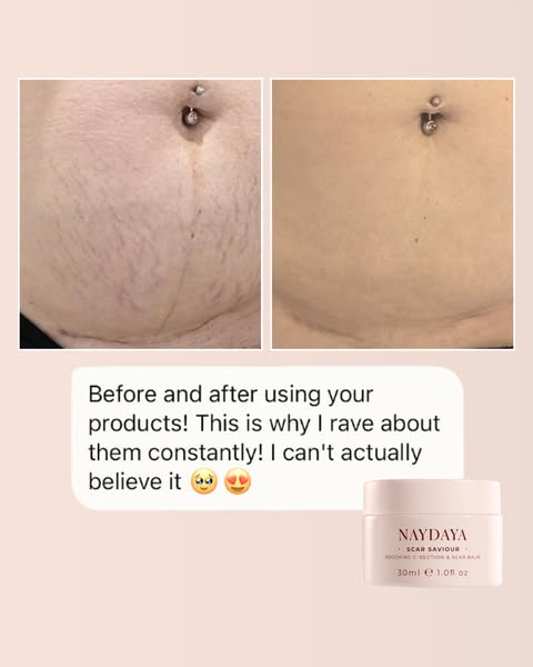C-section scar recovery balm