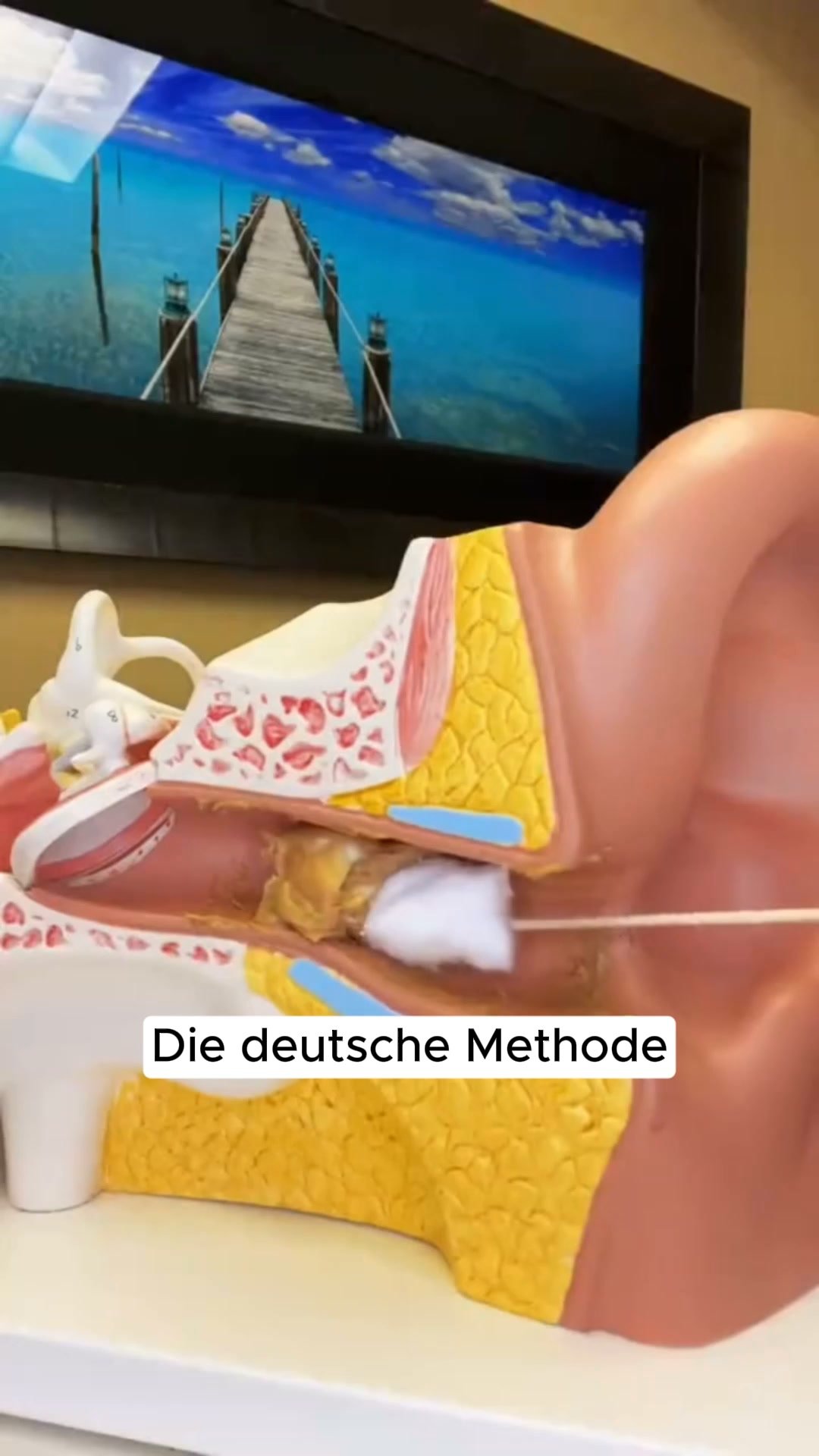 Wattestäbchen schieben Ohrenschmalz tiefer
