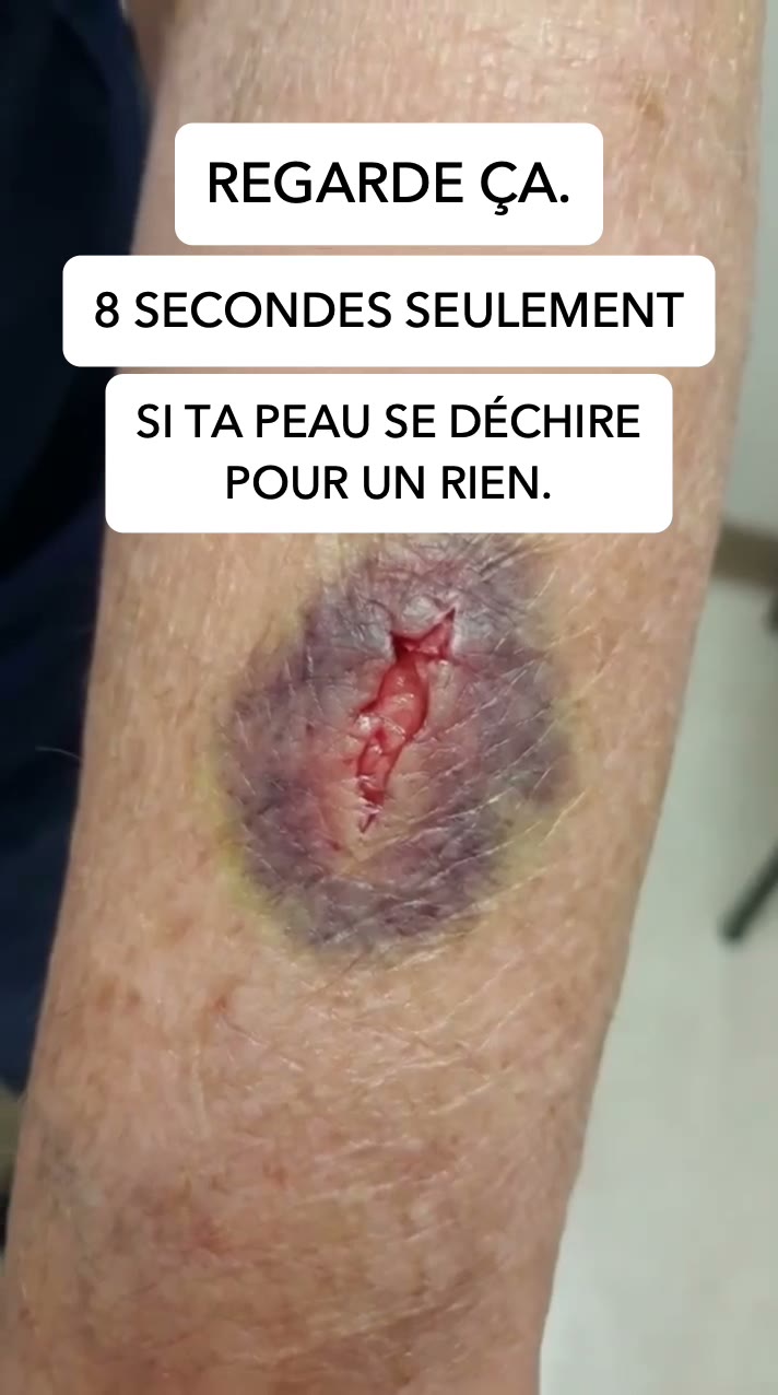 Stop aux bleus au moindre choc