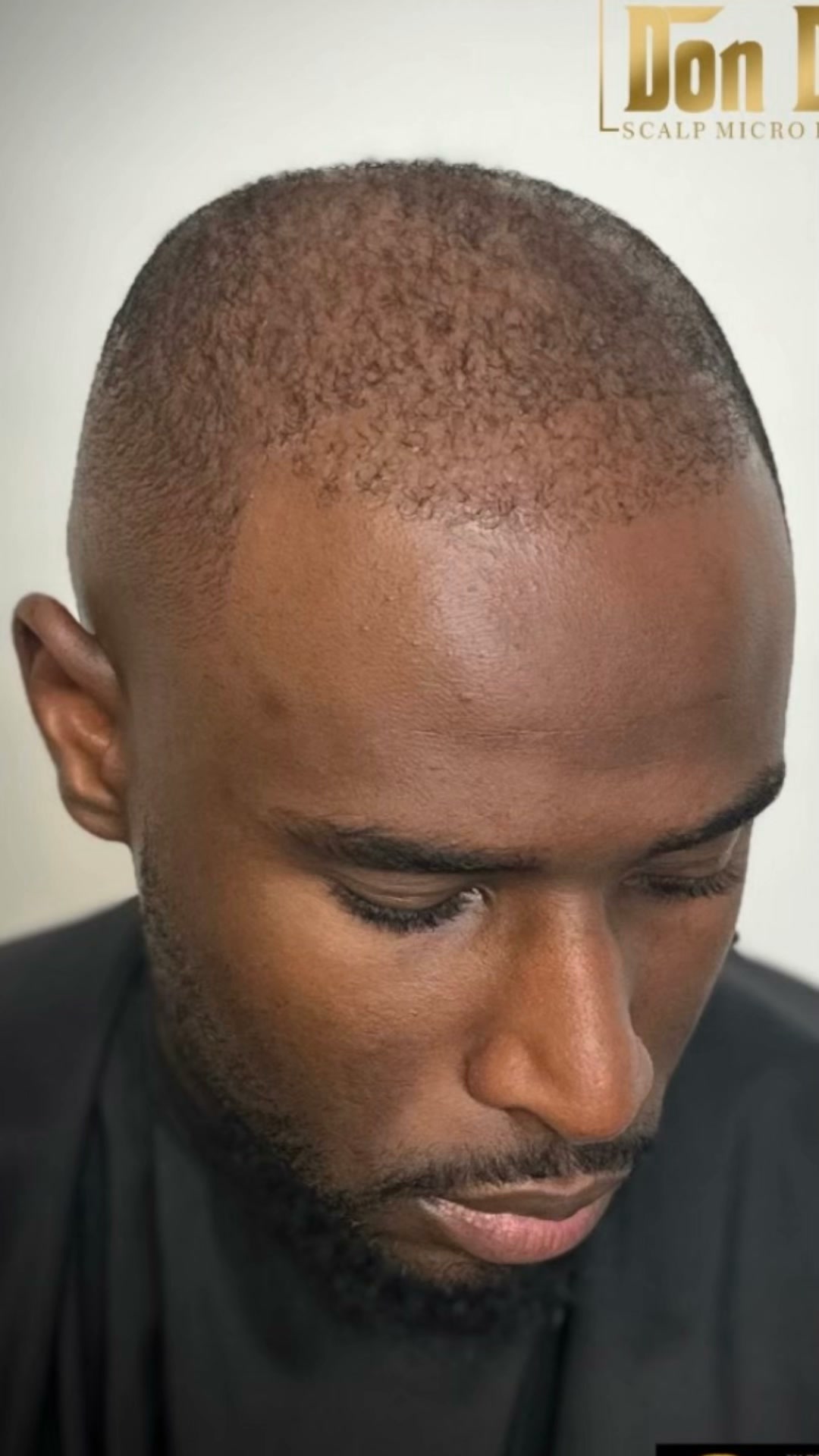 England – 15% Off Scalp Micropigmentation