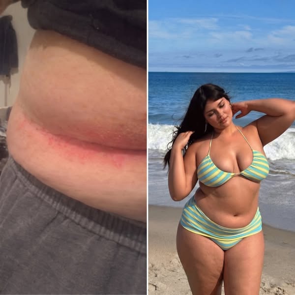 If you have rashes in between your skin folds...Do this