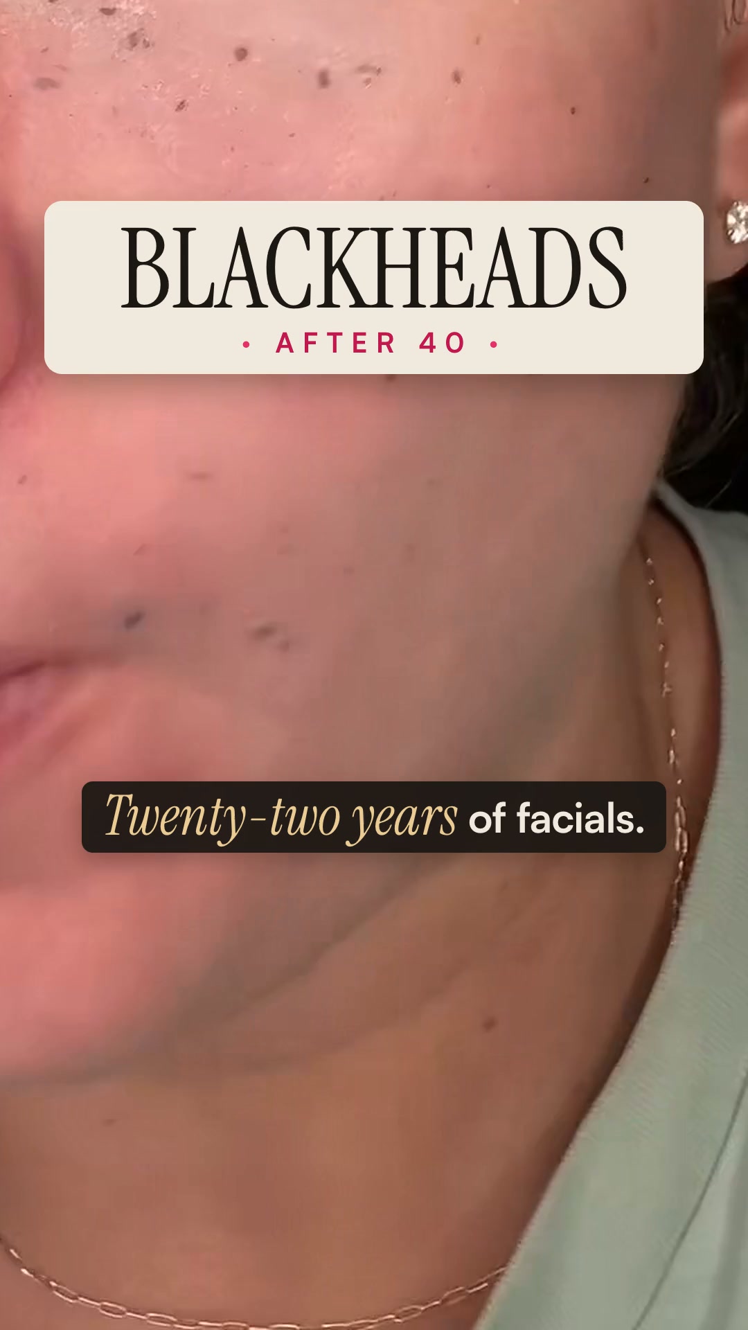 Say goodbye to blackheads