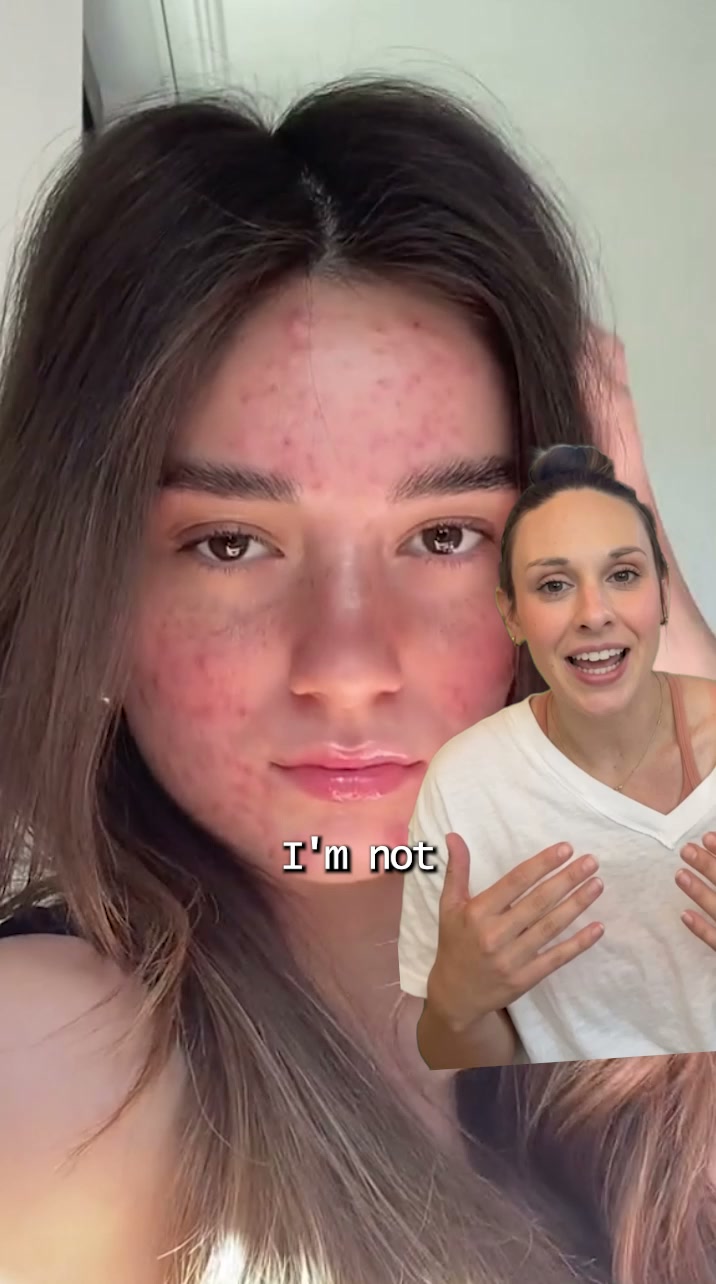 No ACNE or Money Back