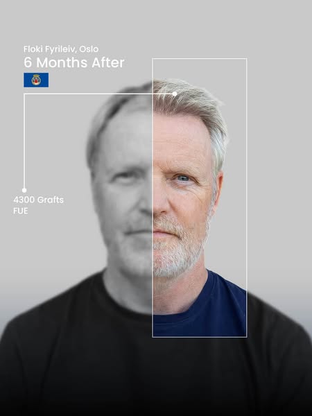 Hair Transplant in Turkey.