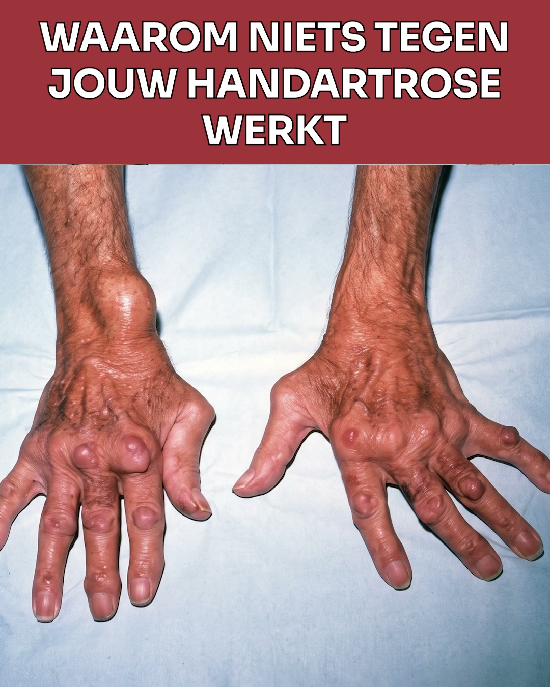 NIEUW: Verlichting bij artrose
