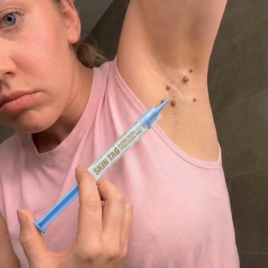 The Painless Way to Remove Skin Tags in 5 Days