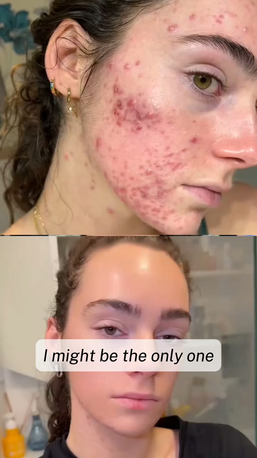 Stop acne now!