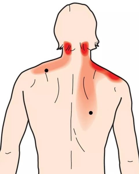 I Was Diagnosed With Chronic Trapezius Tension At 33. I'm 45 Now. My Massage Therapist Melted The Knot Every Week For 12 Years. The Knot Was
