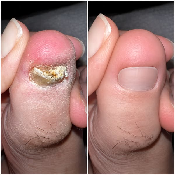 Don't Another $$ On Nail Fungus Treatments