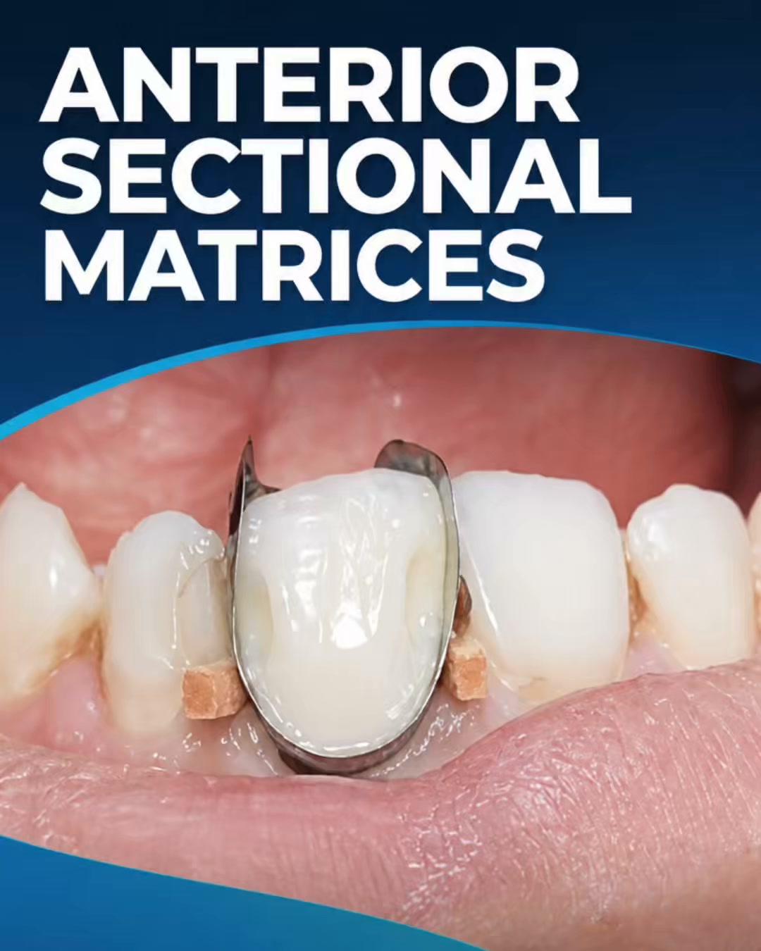 Anterior Sectional Matrices —Natural Contours. Less Finishing Time.