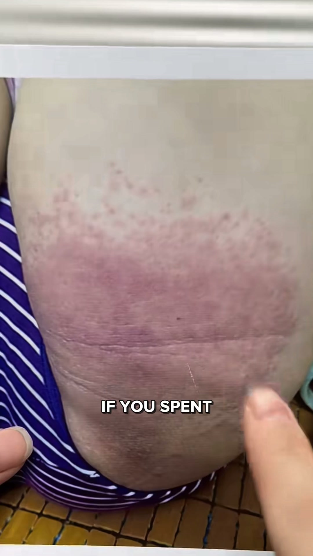Why Your Jock Itch Keeps Coming Back