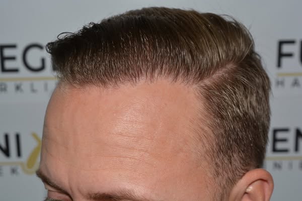 FueGenix | Exclusive Hair Transplant