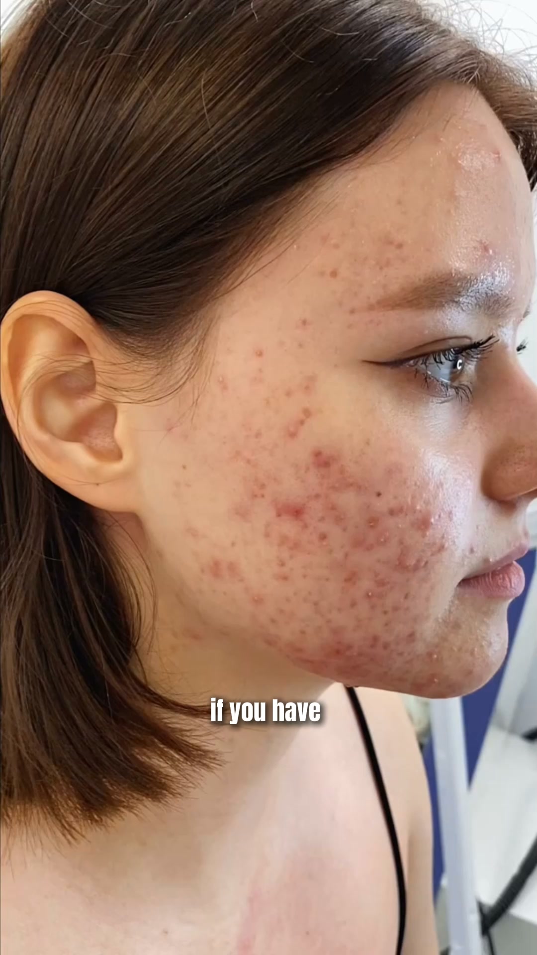 Bright Skin, Simplified
