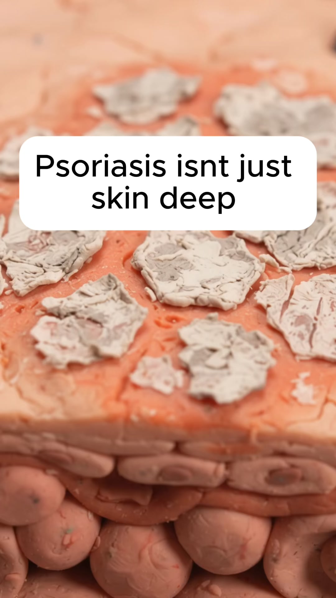 Psoriasis-Prone Skin, Meet Methylene Blue.