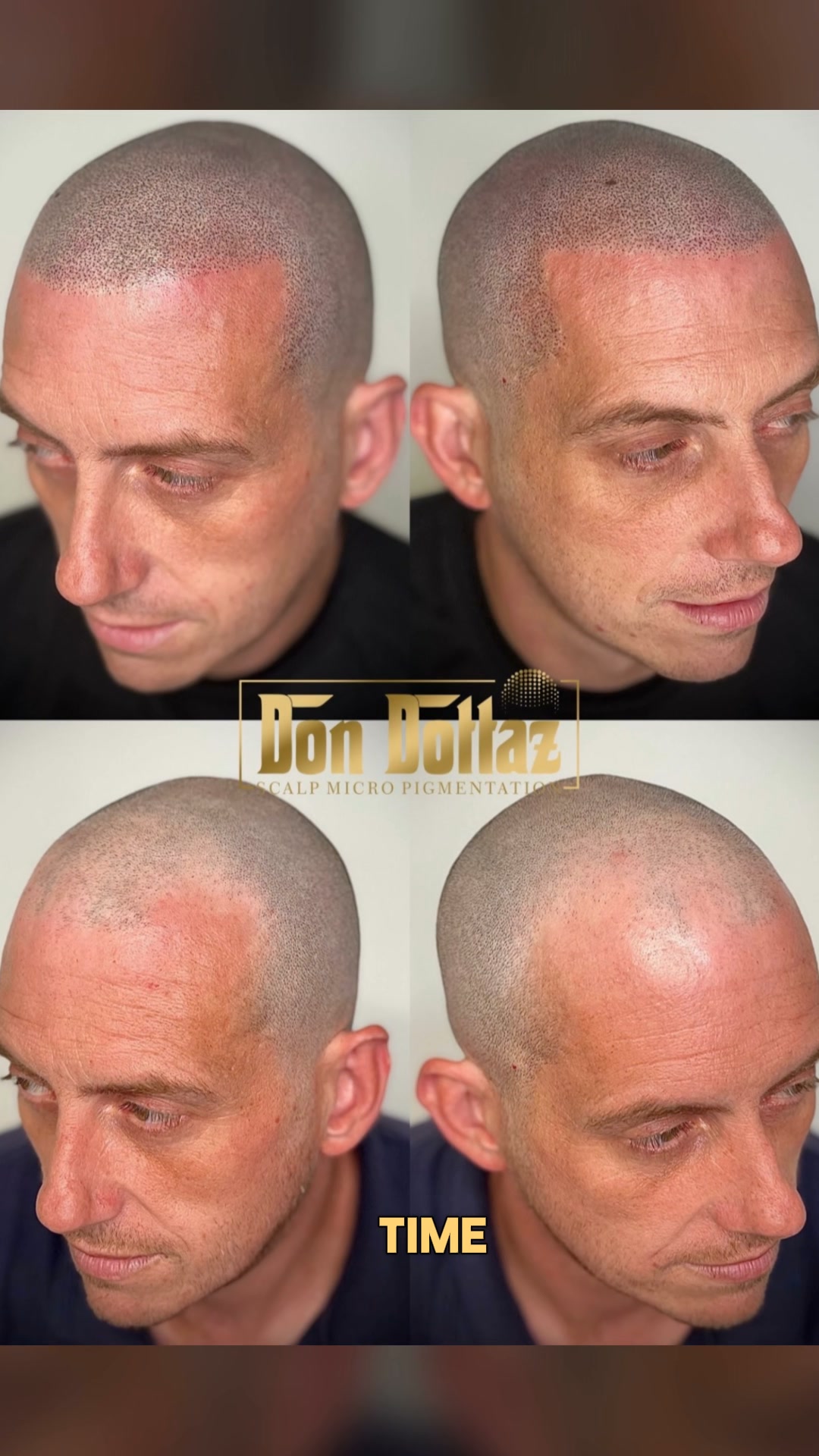 England – Fight Back Against Hair Loss