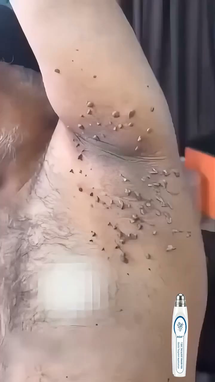 The Painless Way to Remove Skin Tags in 5 Days