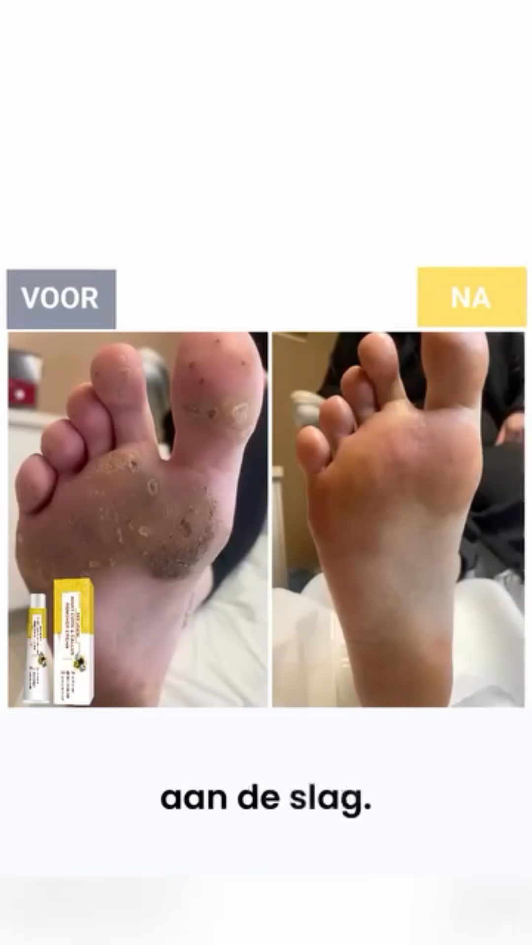 Van Ruwe Naar Zichtbaar Gladdere Voeten >>