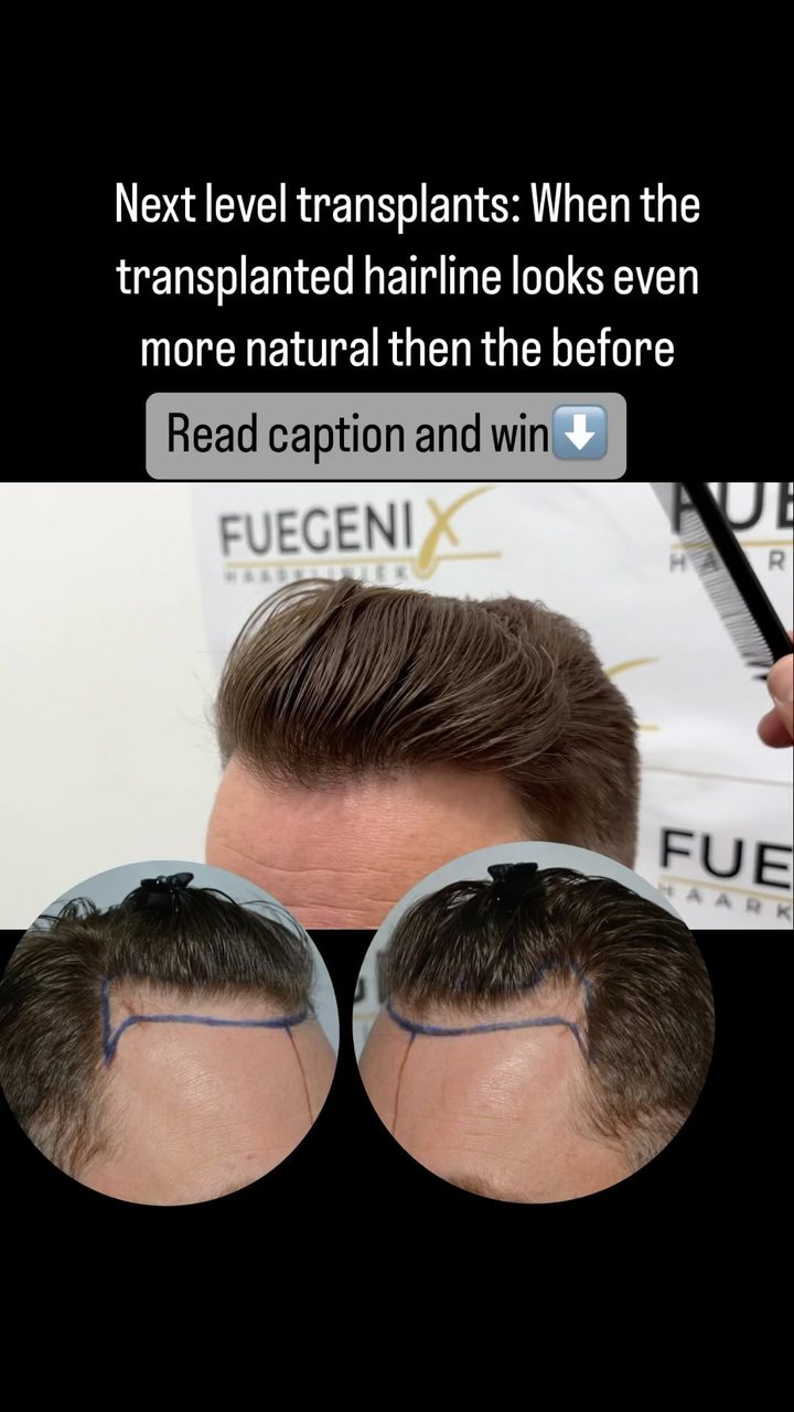 Anúncio de FueGenix Haarkliniek