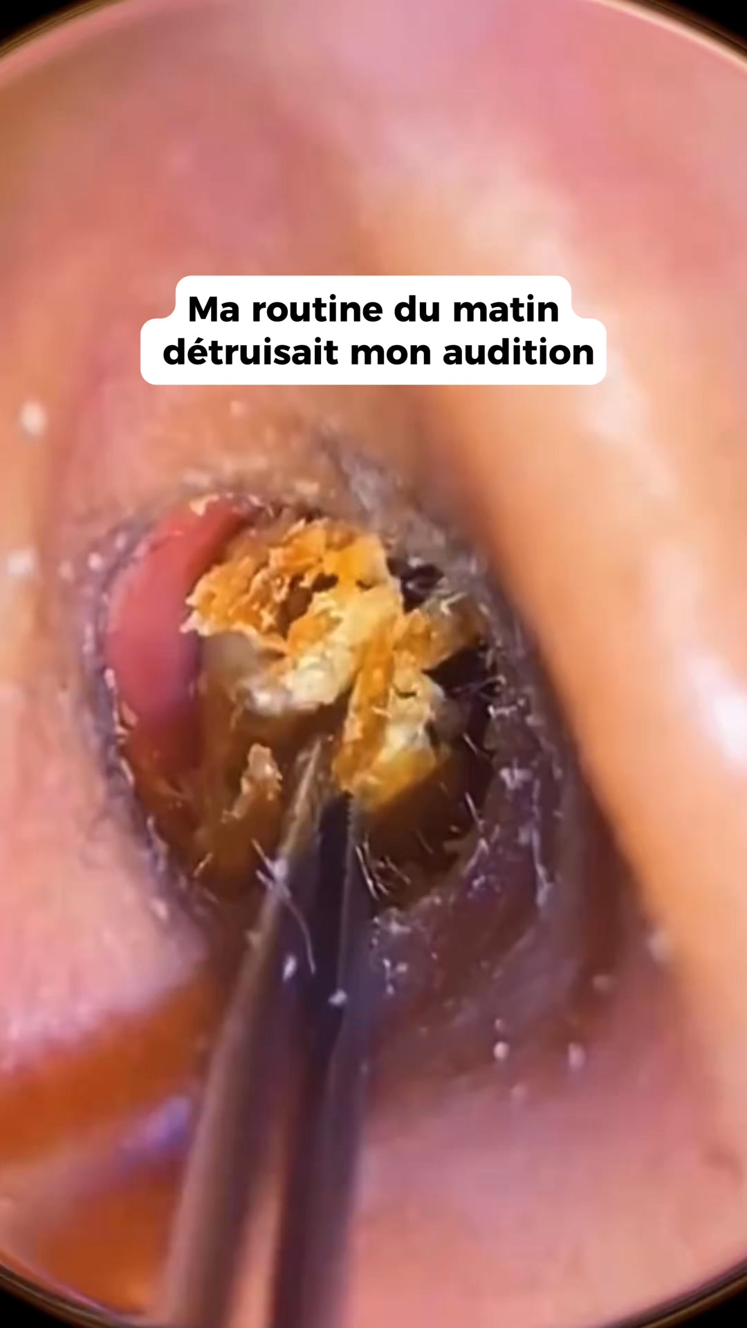 La solution validée techniquement par les ORL