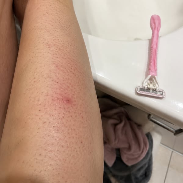 That red bump after shaving isn't inevitable