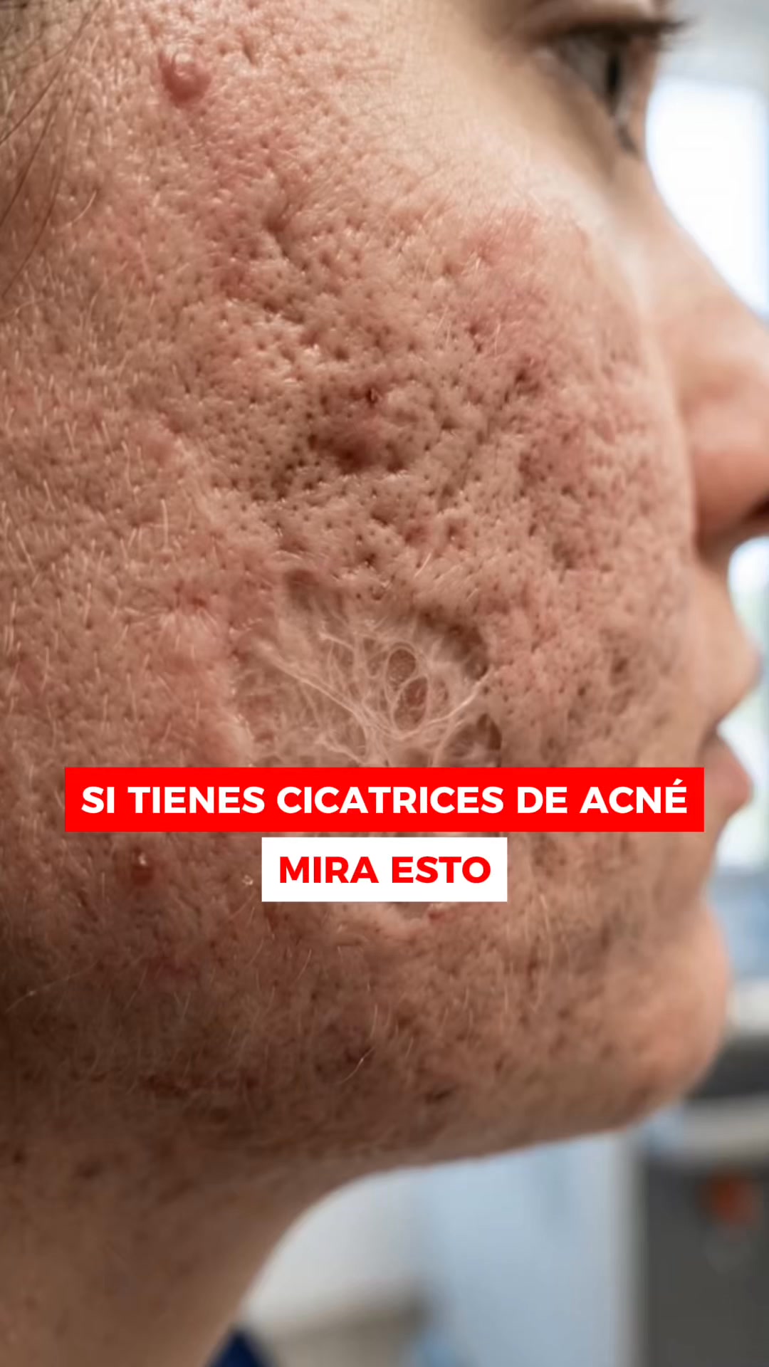 Si Tienes Marcas Mira Esto