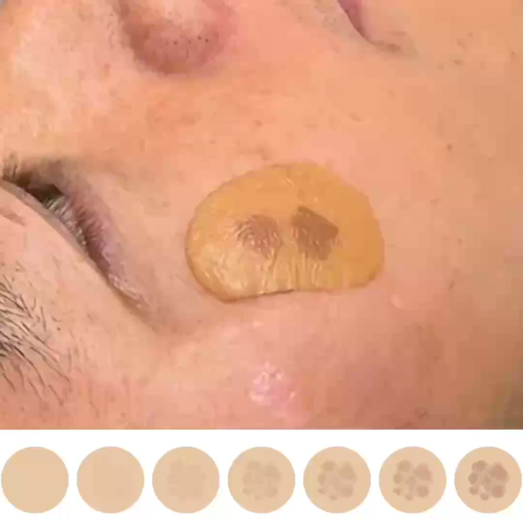 How to Stop Dark Spots Where They Start