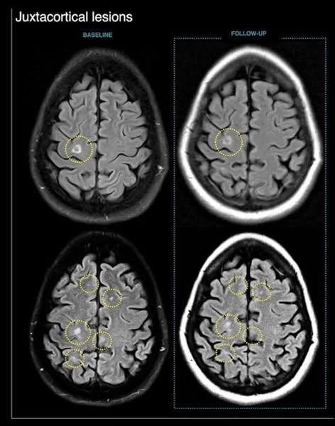 I Refused to Fight My MS With Daily Amantadine
