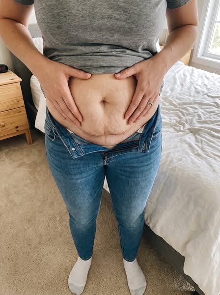 Three years after my C-section, the fold above the scar finally gave.