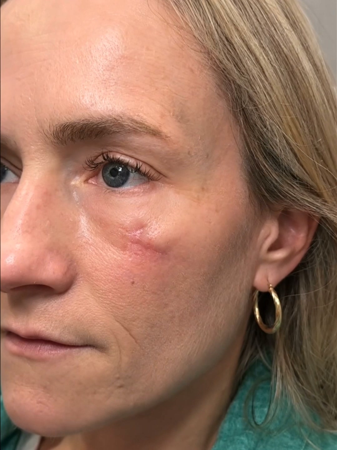 Clear Silicone Scar Care For Fully Healed Scars