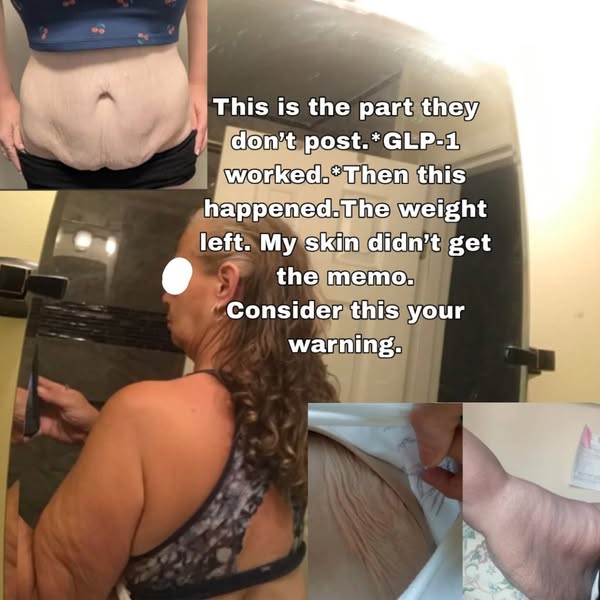 My answer for the saggy skin Ozempic left behind