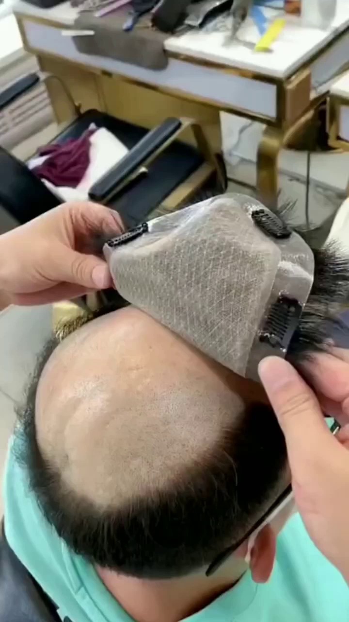 A Guide to Non-Surgical Hair Restoration