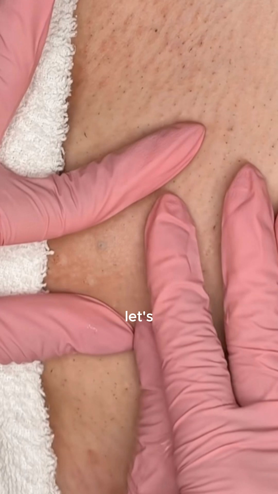 Finally something that actually works for strawberry legs