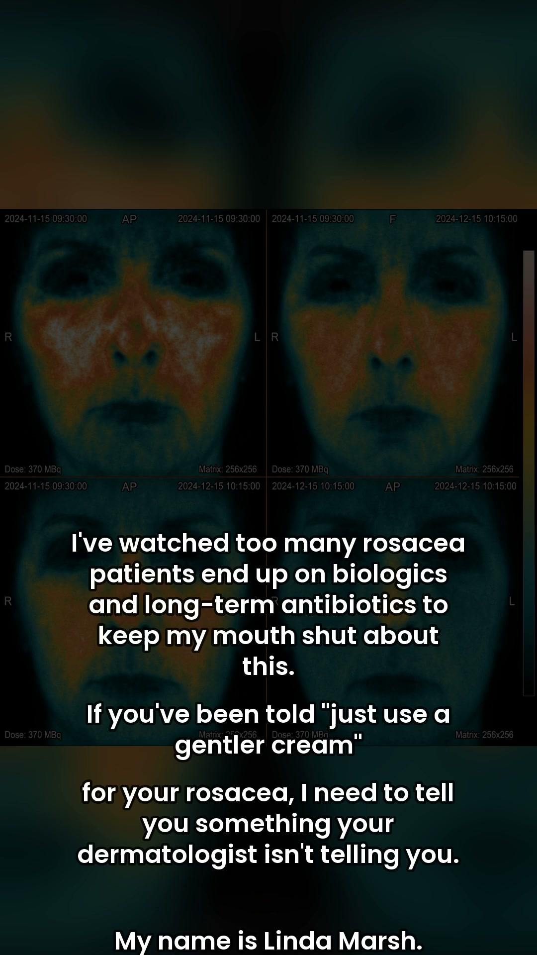 Rosacea? It's Not About Your Skin...