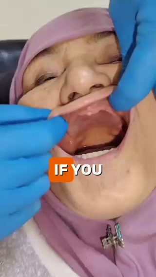 "I used to apply denture adhesive 3–4 times a day"