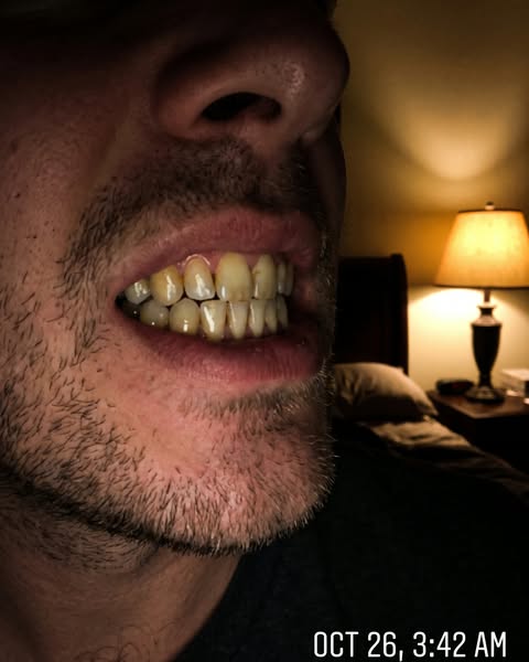 [WARNING] Yellow teeth that strips won't fix? That is not a stain. That is your enamel wearing thin, and it does not grow back.