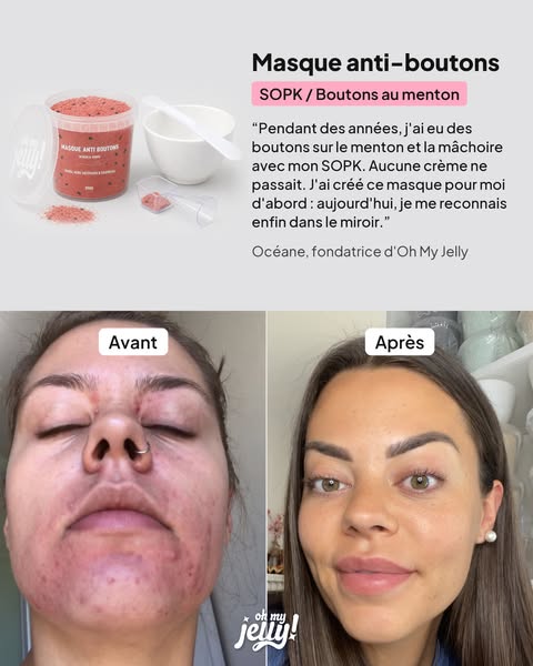 SOPK : 91 % ont vu leurs boutons réduits en 4 semaines. Sans toucher aux hormones.
