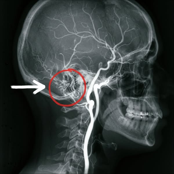 Your tinnitus is sending you a warning.