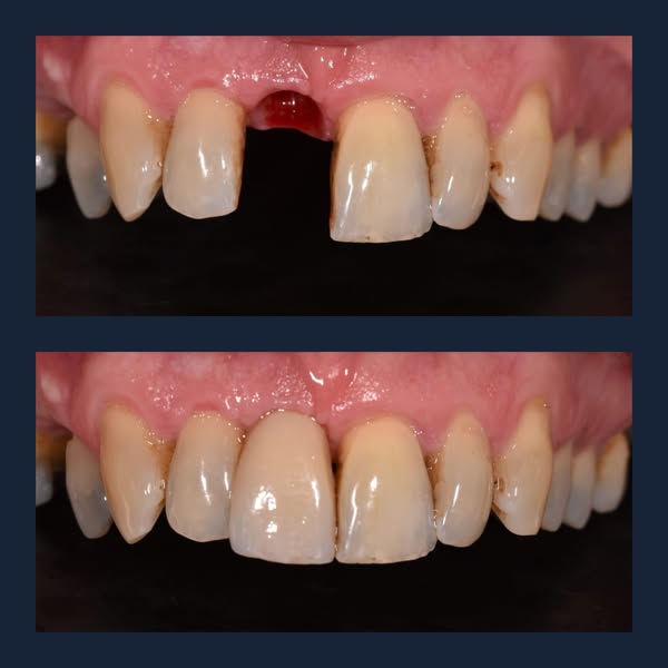 Missing Teeth? We're Here to Help