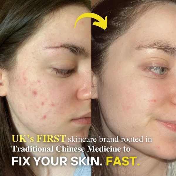 Calm Skin Without Burning Or Stripping
